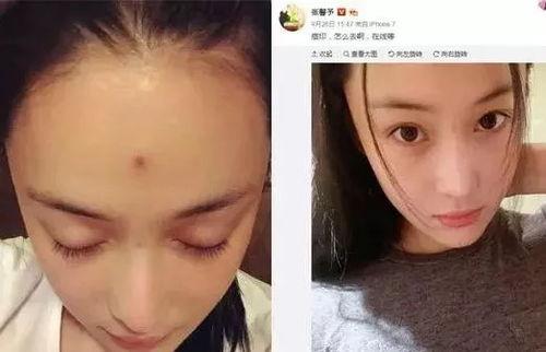 长痘明星,揭秘长痘明星的护肤秘籍与心路历程